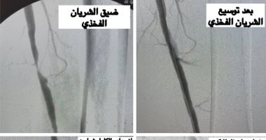 إنقاذ حياة 3 حالات بمستشفى القناطر الخيرية المركزى من بتر السيقان بجراحات عاجلة