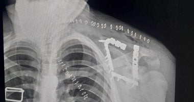 التأمين الصحى بالفيوم ينقذ شابا أصيب بكسر مفتت بلوح الكتف