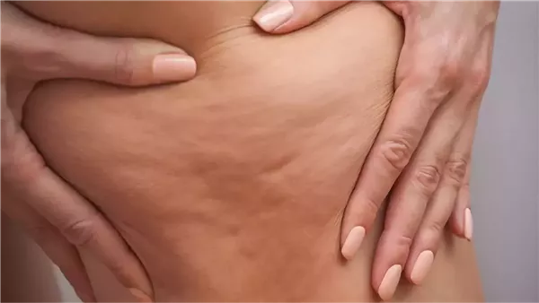 5 علامات تدل على أنك مصابة بالليبيديما وليس سيلوليت