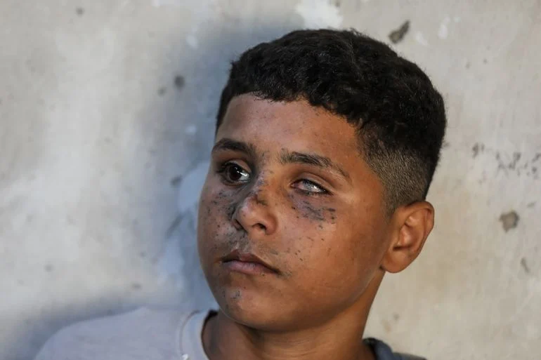 عادل العشي.. طفل غزي فقد عينه وسمعه في قصف إسرائيلي وهو يلعب الكرة