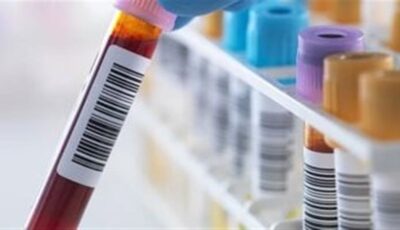 أعراض ارتفاع الصوديوم وأسبابه وطرق العلاج