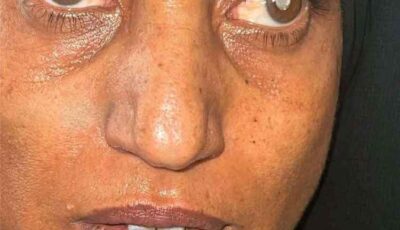 المشهد اليمني – بعد 5 سنوات من المعاناة.. مفاجأة طبية تنهي مأساة شابة عشرينية في مخيم للعيون بالضالع