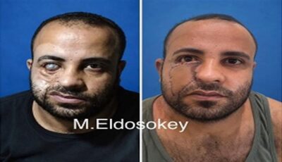 رصاصة خرطوش أبقت عينه مفتوحة 14 عاما.. جراحة مصرية تعيد الأمل لشاب من الصعيد