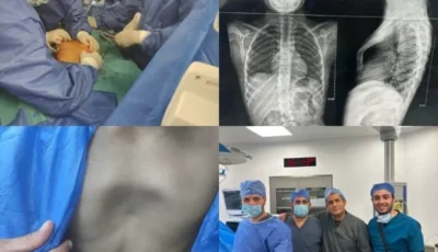 جراحة ناجحة بمستشفيات جامعة بنها تنهي معاناة طفلة من تشوه شديد با