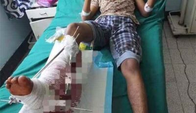 المشهد اليمني – جريح تعز يكشف الفضيحة: بعت بيتي وسافرت على حسابي عشان أعالج إصابتي.. واللجنة الطبية نايمة
