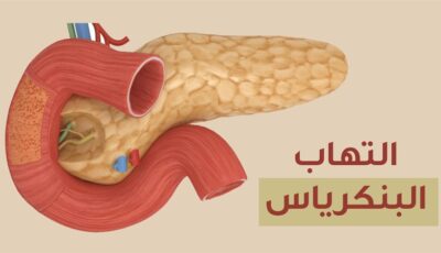 أعراض التهاب البنكرياس، استشاري باطنة يوضح ويحذر من إهمالها