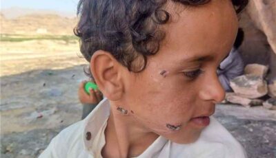 المشهد اليمني – فاجعة تهز اليمن.. أب يبكي طفله بعد أن قتله لقاح فاسد لعضة كلب!
