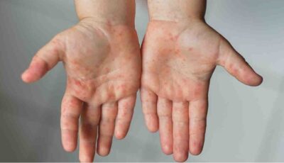 هل يمكن الإصابة بجدري الماء مرتين؟