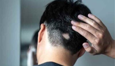 علوم وصحة – بشرة سارة لملايين المصابين بالثعلبة.. دواء لالتهاب المفاصل يعيد الشعر المفقود في 6 أشهر